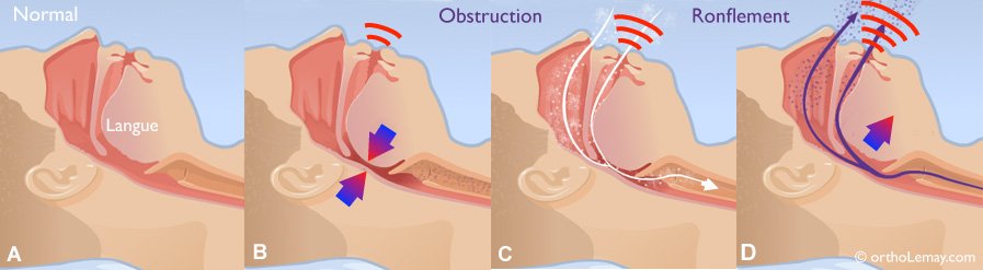Que se passe-t-il, pourquoi est-il dangereux si vous manquez de respirer pendant le ronflement ?
